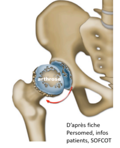 Coxarthrose ou arthrose de la hanche