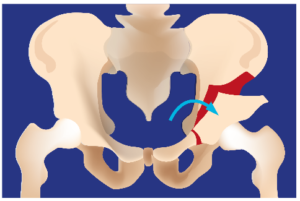 Chirurgie Orthopédique Nantes - ostéotomie hanche réorientation