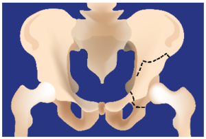Chirurgie Orthopédique Nantes - ostéotomie hanche
