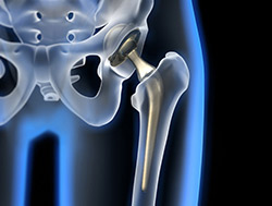 prothèse totale de la hanche (PTH)